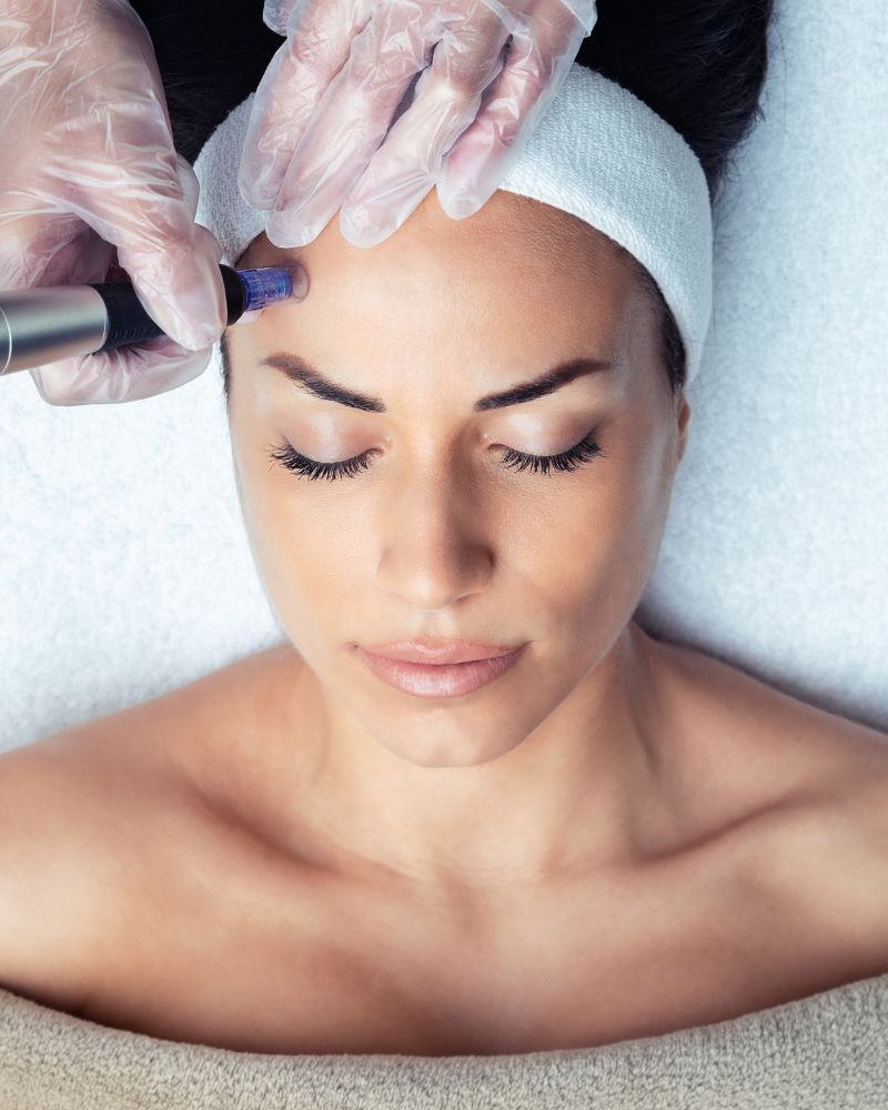 Women getting microneedling treatment